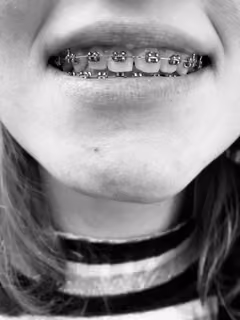 Black and white close-up of a teenager's smile with braces